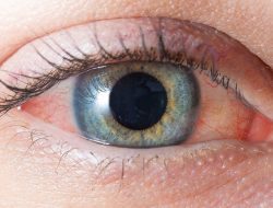 Penyebab Mata Berdarah dan Faktor Risikonya