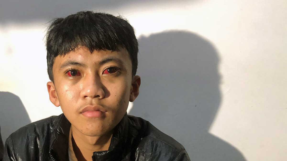 Salah satu korban gas air mata Kanjuruhan, bola matanya masih memerah (blok-a.com/Putu Ayu)