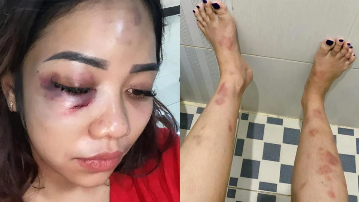Foto korban penganiayaan pacar yang selingkuh (ist)