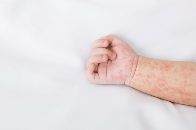 Ilustrasi bayi menderita penyakit Campak. (Shutterstock/Prostock-studio)
